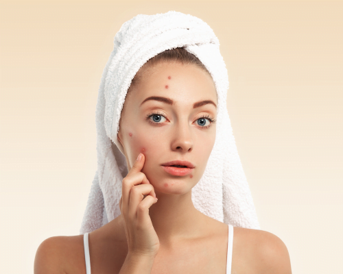 Treatment of Active Acne