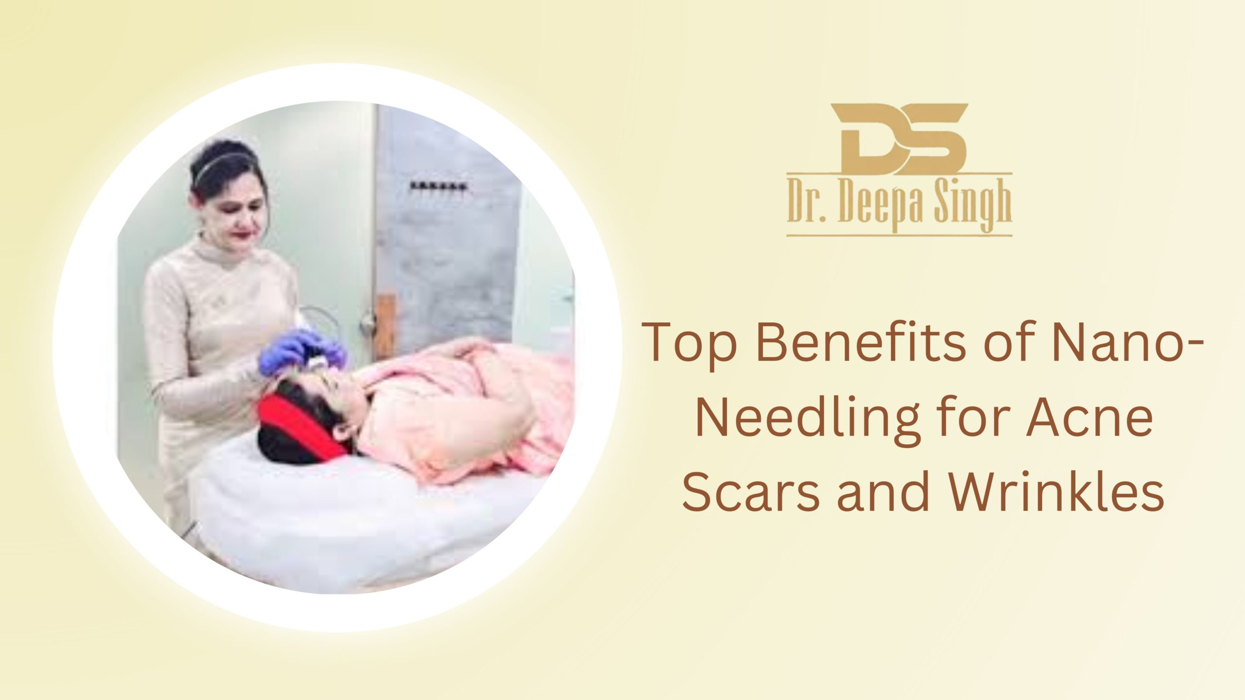 Nano-Needling for Acne Scars and Wrinkles treatment results